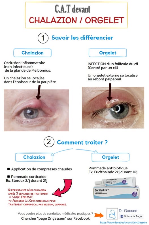 C.A.T devant CHALAZION   ORGELET